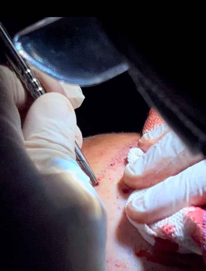 INCISÃO